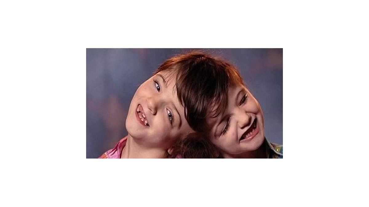 Increíble historia de las siamesas Tatiana y Krista, unidas por el cerebro