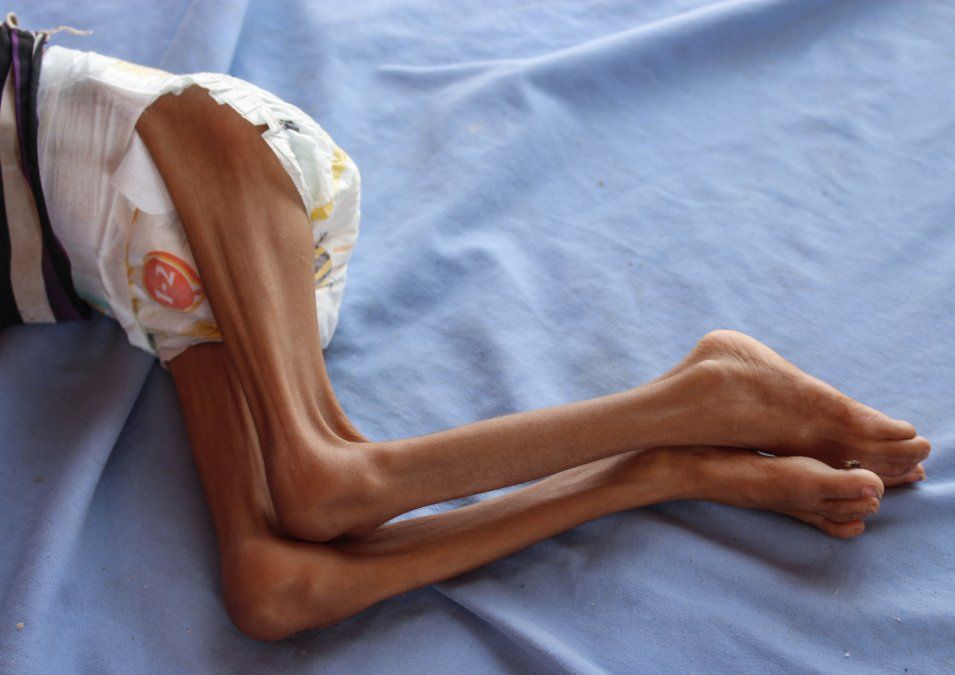Un niño yemení que padece desnutrición yace en una cama de un hospital en el distrito de Abs en el noroeste de Haijah. Un niño yemení que padece desnutrición yace en una cama de un hospital en el distrito de Abs en el noroeste de Haijah.