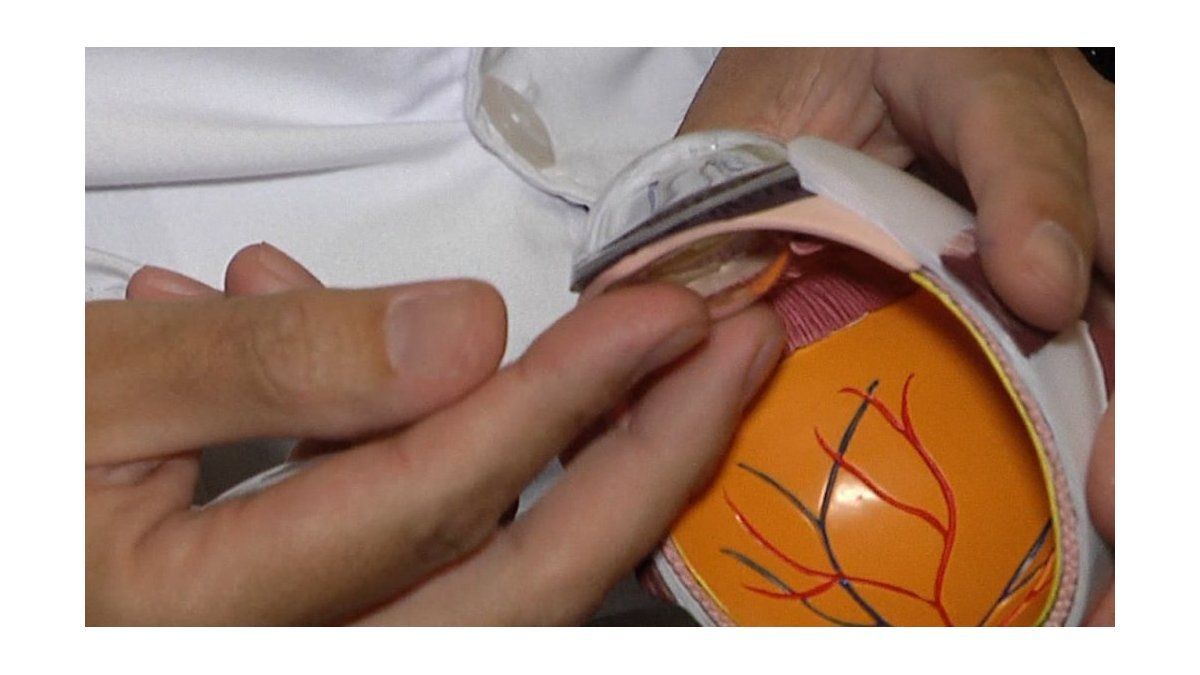 Uruguay aprueba nueva lente intraocular para pacientes con cataratas