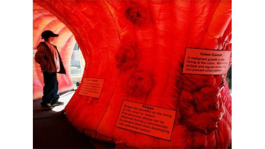 Se diagnostican 4 casos de cáncer de colon por día en Uruguay