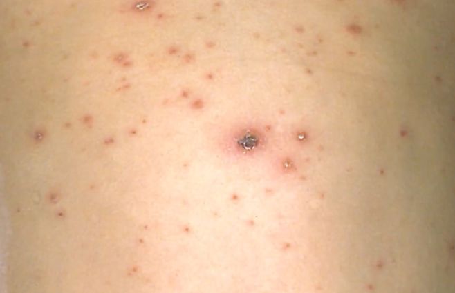 varicela-uruguay-vacuna