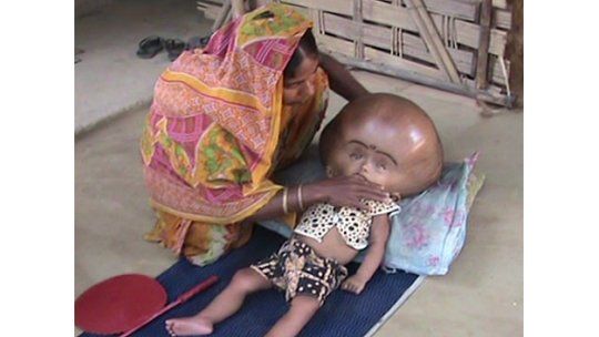 Niña india con hidrocefalia desata campaña de ayuda internacional