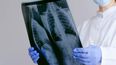 profesor agregado de cirugia de torax explico las caracteristicas de un nodulo pulmonar, tras el anuncio del papa leon