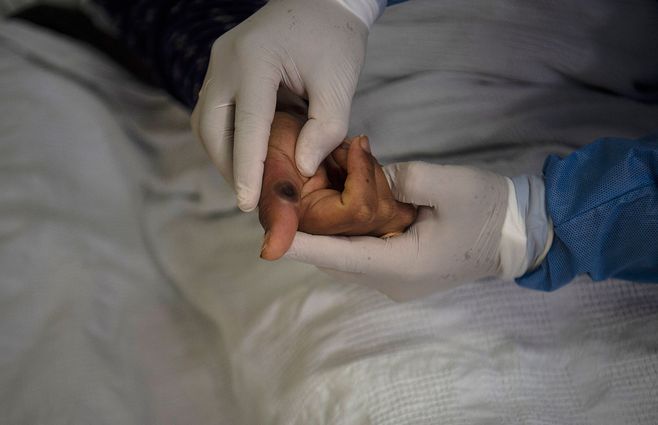 viruela-del-mono-paciente-internada-AFP.jpg