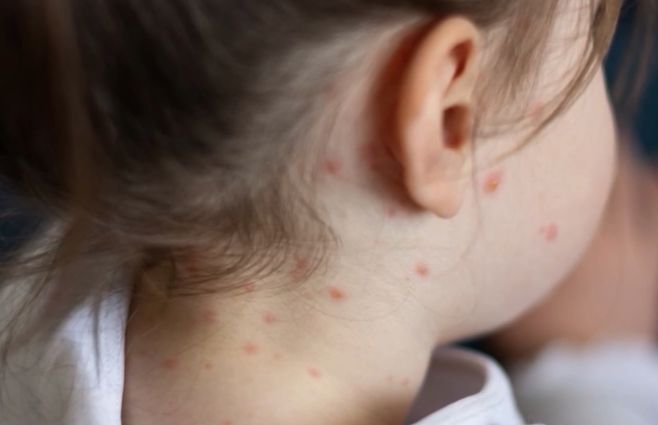 sarampion-niña-archiv