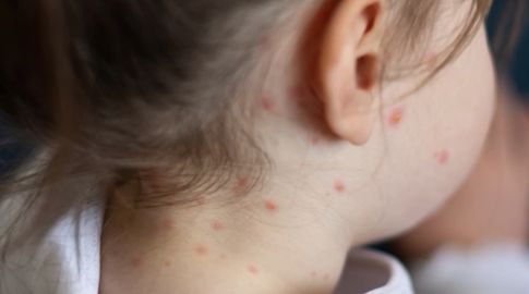 Cinco casos sospechosos de sarampión más a estudio y 20 mil niños en el país que no tienen la vacuna, dijo la ministra