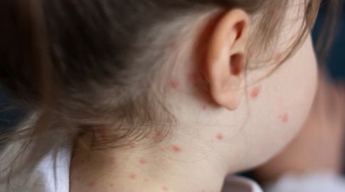 Sarampión en Uruguay: Hay 11 casos confirmados de la enfermedad y 20 sospechosos en 11 departamentos Sarampión en Uruguay: Hay 11 casos confirmados de la enfermedad y 20 sospechosos en 11 departamentos