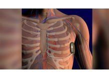 Cardiólogos exigen que FNR financie implante de desfibriladores subcutáneos