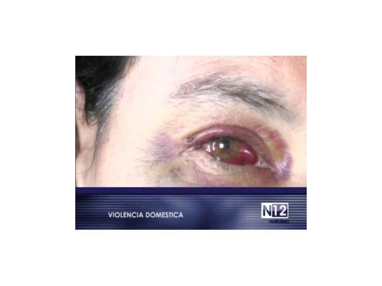 Mujer golpeada por ex pareja mostró sus heridas a la TV