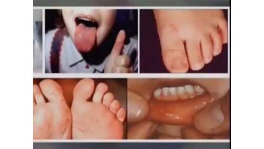 Cómo atender el síndrome “mano-pie-boca”, muy común en esta época