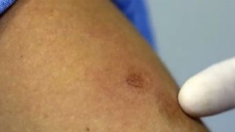 estados unidos declara emergencia de salud publica por avance de la viruela del mono