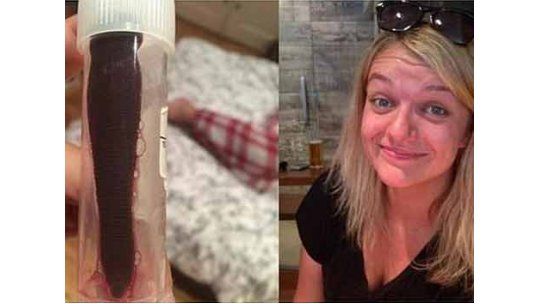 Extirpan una sanguijuela de 7 cms. de la nariz de esta mujer