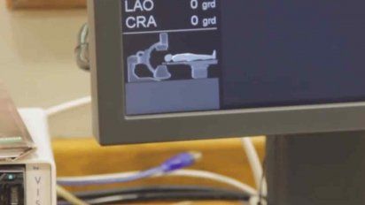 el angiografo del hospital regional de tacuarembo realizo este jueves una embolizacion cerebral