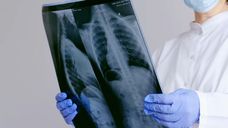 Profesor de cirugía de tórax explicó las características de un nódulo pulmonar, tras anuncio del papa León