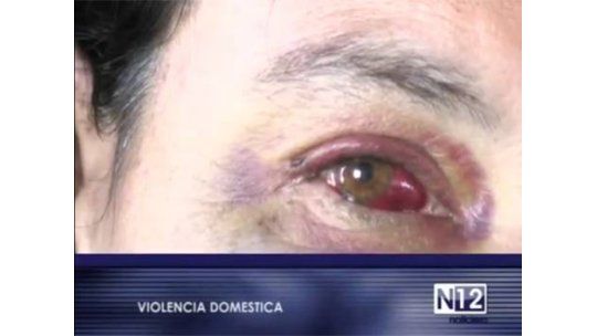 Mujer golpeada por ex pareja mostró sus heridas a la TV