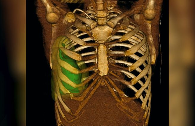 tumor-operacion-maciel