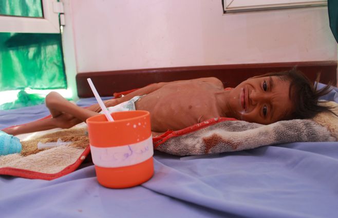 Un ni&ntilde;o yemen&iacute; que sufre desnutrici&oacute;n fotografiado en julio de 2020. La guerra en este pa&iacute;s ha provocado una crisis humanitaria con el c&oacute;lera y la violencia como tel&oacute;n de fondo