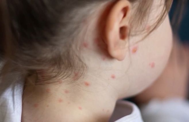 sarampión-niños-vacunas