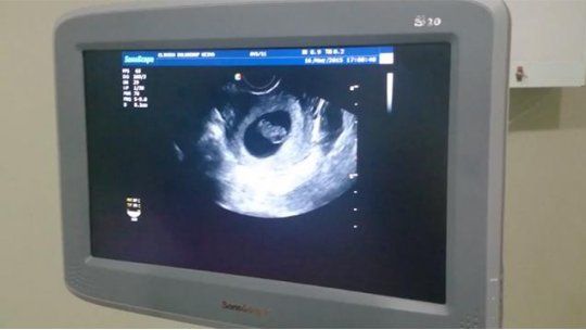 ecografía