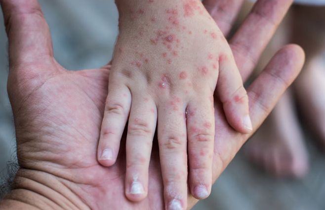 niñoa-sarampión-eeuu