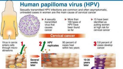 El VPH puede aparecer 30 años después convertido en cáncer