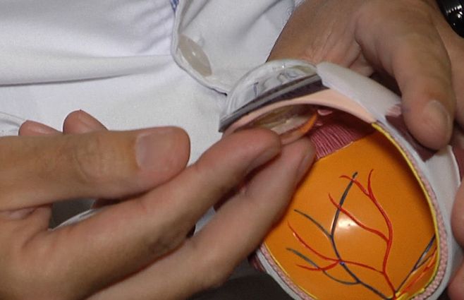 La lente intraocular es flexible y construida con materiales nobles