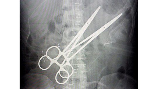 Vivió 16 años con unas pinzas en su abdomen