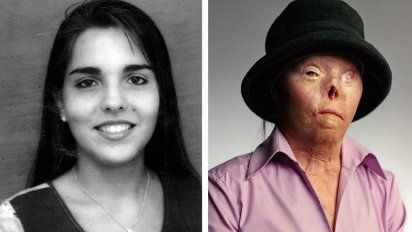 Saburido antes y después del accidente de 1999