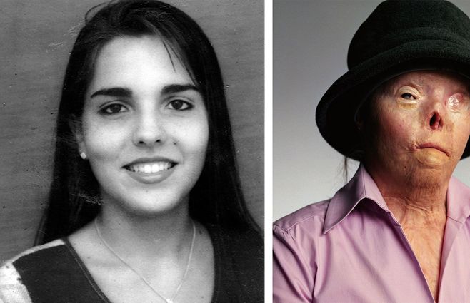 Saburido antes y después del accidente de 1999