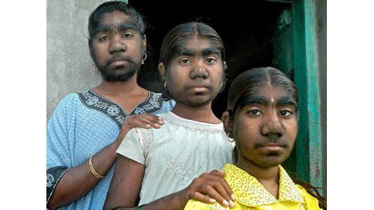 Tres hermanas indias viven con el síndrome del hombre lobo