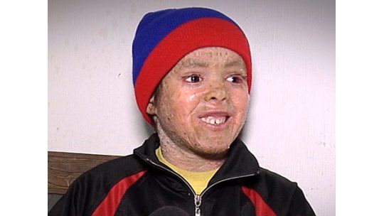 Ismael sufre de ictiosis laminar y necesita ayuda