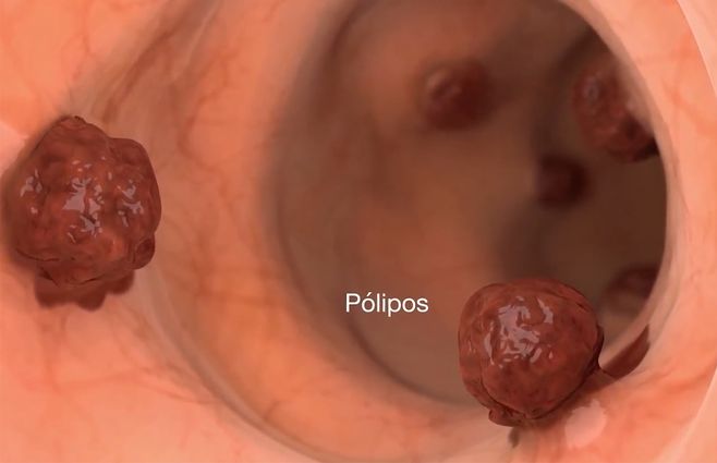 polipos-cancer-colorrectal.jpg