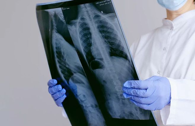 Profesor Agregado de Cirugía de Tórax explicó las características de un nódulo pulmonar, tras el anuncio del papa León