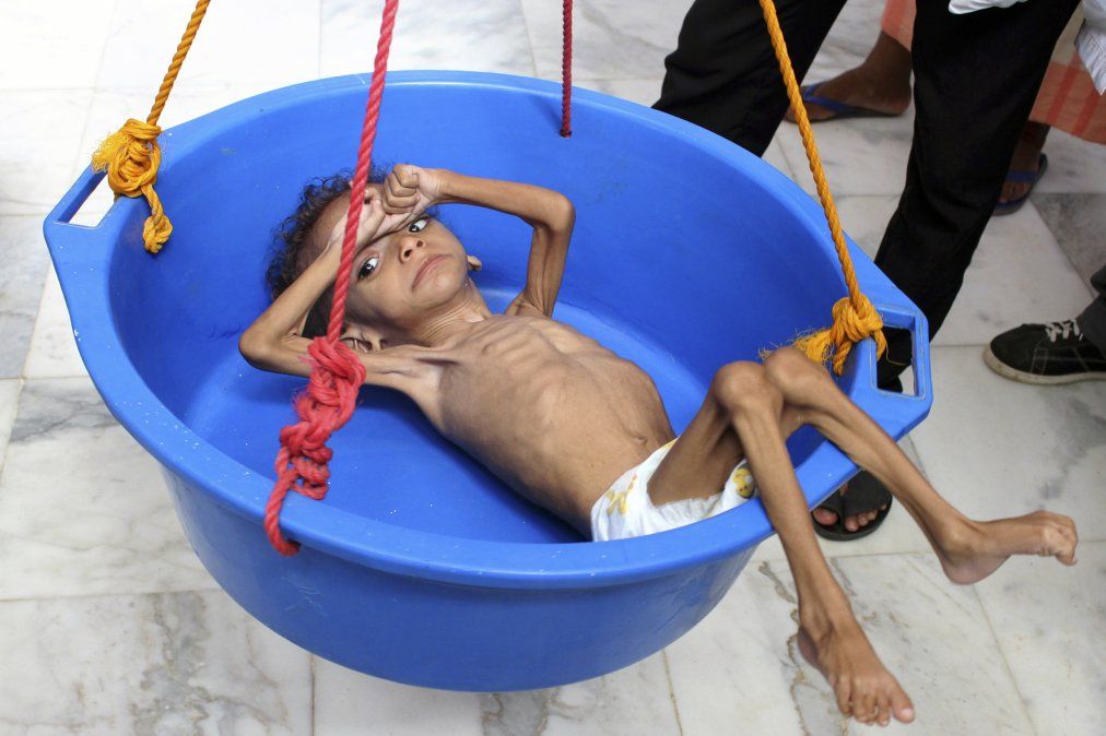 Un niño yemení que sufre desnutrición es pesado en un hospital en el norte del distrito de Abs, en la provincia de Hajjah.