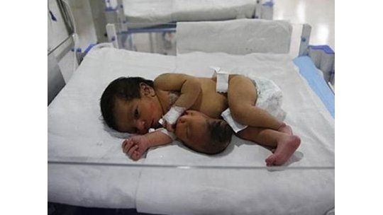 Caso del  hermano parásito conmociona a la India