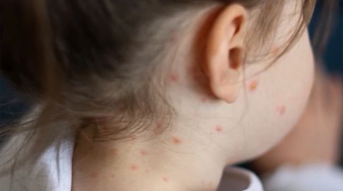 Los casos de varicela registrados en 2026 son 65% superiores a los reportados el año pasado Los casos de varicela registrados en 2026 son 65% superiores a los reportados el año pasado