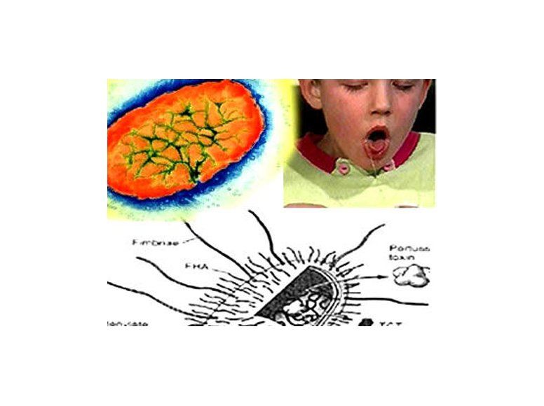 Octubre: mueren dos bebés menores de un mes por tos convulsa