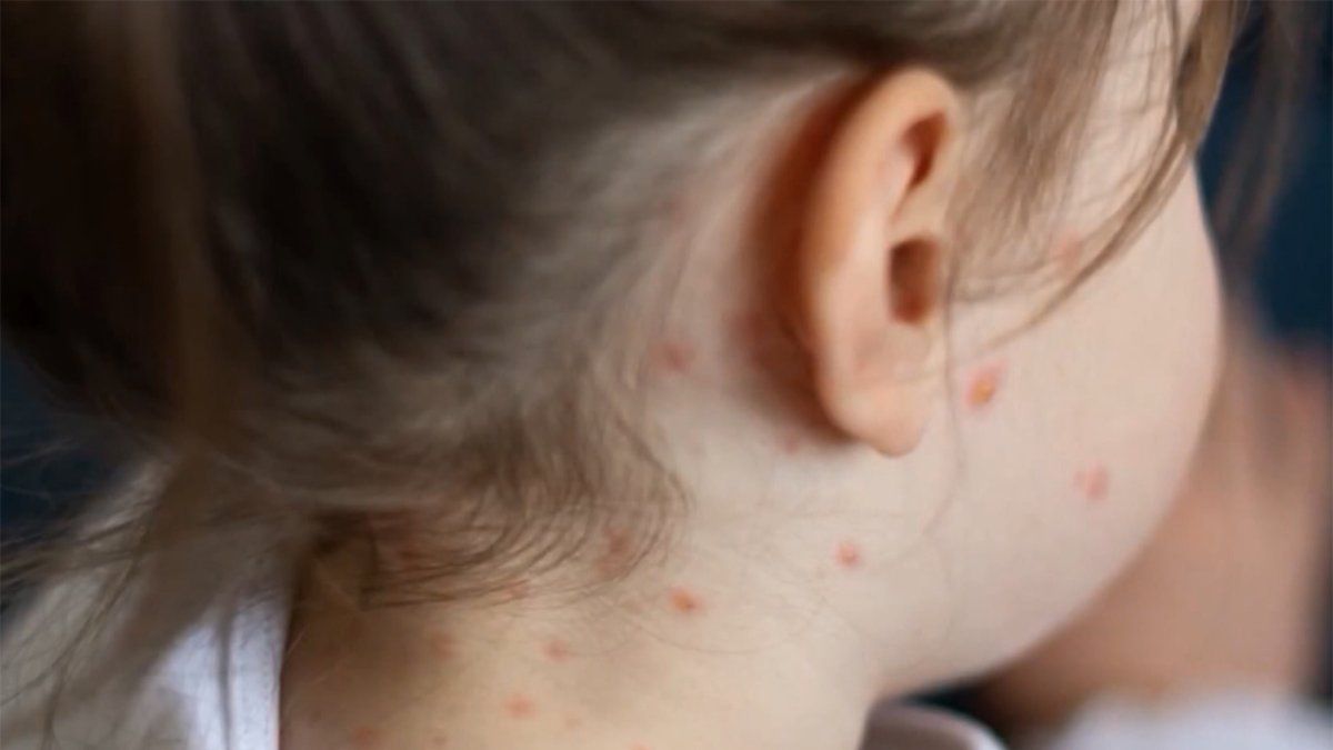 Más de 40.000 dosis contra el sarampión aplicadas desde noviembre; MSP habilitó un formulario para viajeros