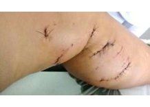 Pitbull mordió a menor en Playa Grande causándole heridas de consideración