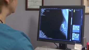 evaluan bajar la edad recomendada para la mamografia; actualmente es desde los 50 anos