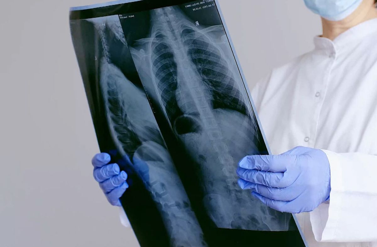 Profesor Agregado de Cirugía de Tórax explicó las características de un nódulo pulmonar, tras el anuncio del papa León