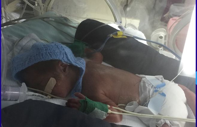 prematuro-bebé-uruguay