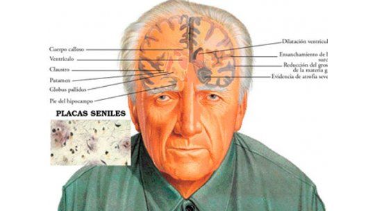 Mutación genética previene contra la aparición del alzhéimer