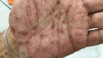 sifilis en uruguay: registran aumento sostenido y msp lanza campana de concientizacion