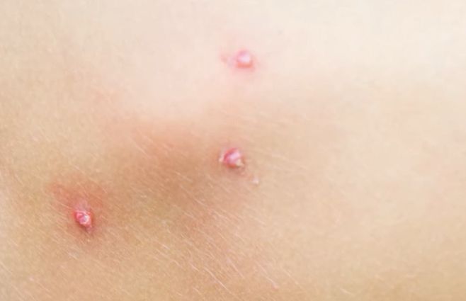 varicela-msp-salud-ministerio