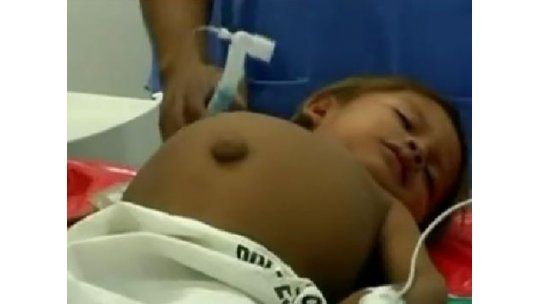 Niño de 3 años tenía un feto de 700 gramos en su abdomen
