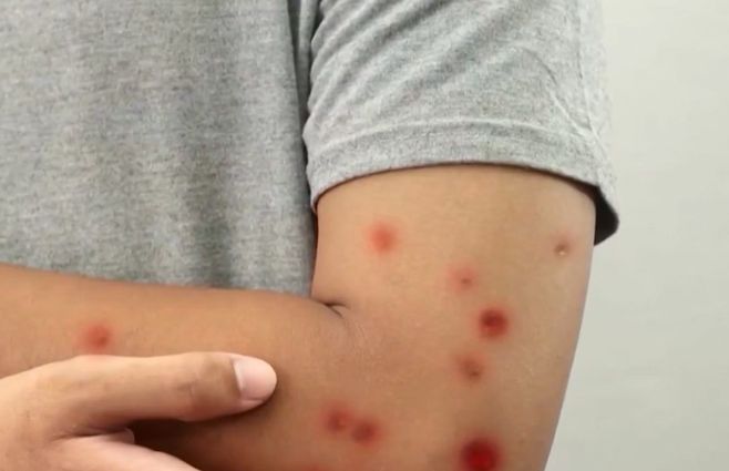 sarampión-msp-enero