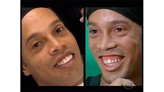 Así fue el tratamiento dental que se hizo Ronaldinho Gaúcho